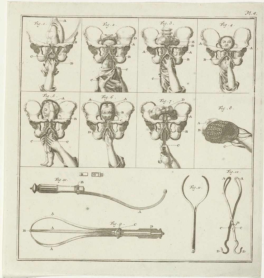 Gynaecologische voorstellingen (1730 - 1791) by Nicolaas van Frankendaal and C Plevier
