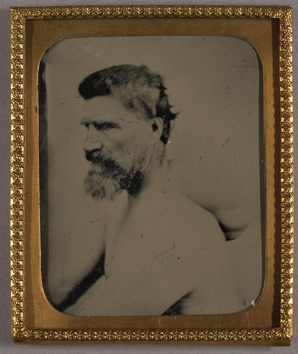 Portrait of a Bearded Man with Abnormal Hump Growth on Back