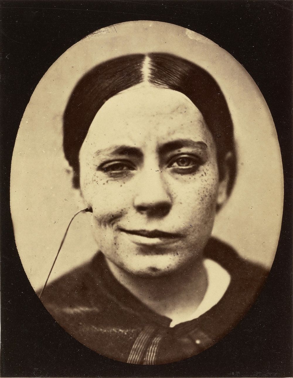 Electro-Physiologie Photographique (Portrait of a Woman), Fig. 35 by Guillaume Benjamin Duchenne and Adrien Alban Tournachon