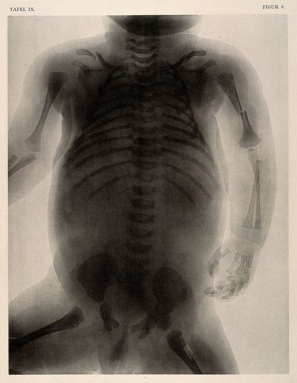 A skeleton of a new born child with deformed hips who died of asphyxia in birth. Collotype by Römmler & Jonas after a…