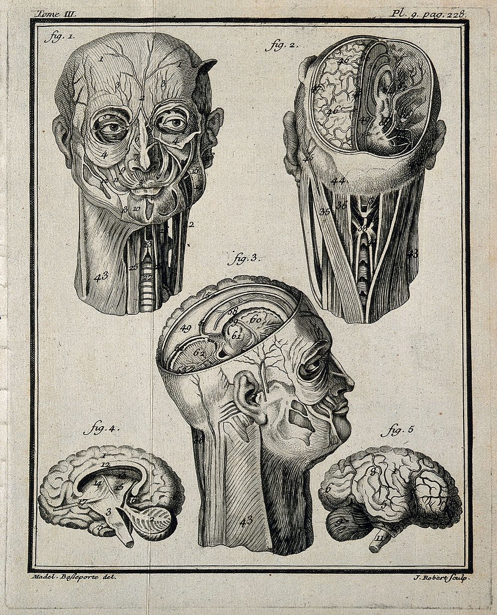 Wax models of the head and neck (figs 1-3), and of the right hemisphere of the brain (figs 4-5), made by G. G. Zumbo.…