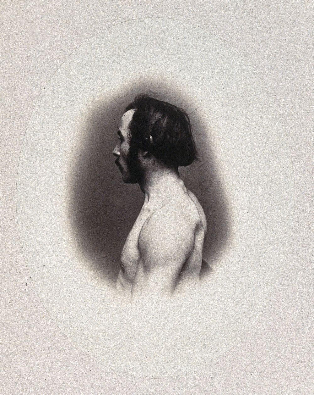 A man's head and left shoulder, unclothed and viewed from the side. Photograph by L. Haase after H.W. Berend, 1865.