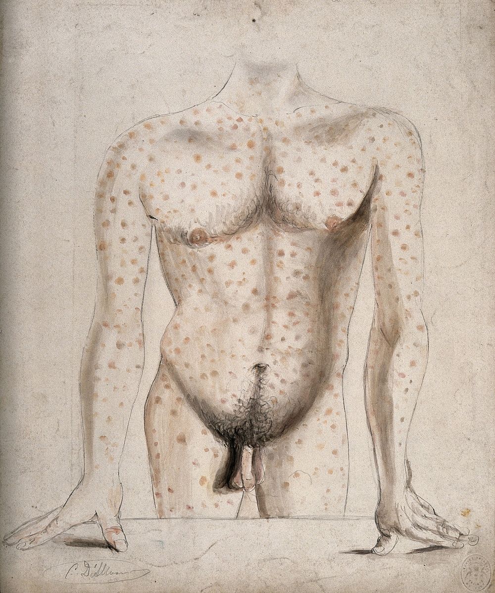 The torso, arms and upper thighs of a man suffering from a rash of sores. Watercolour by C. D'Alton, ca. 1853.