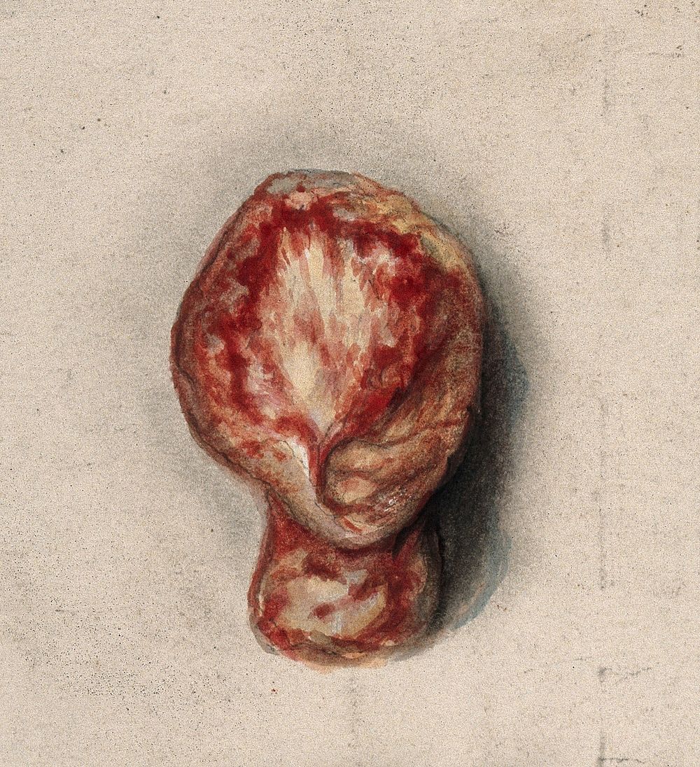 Section of a testicle removed from a man suffering from tertiary syphilis. Watercolour by C. D'Alton, 1858.