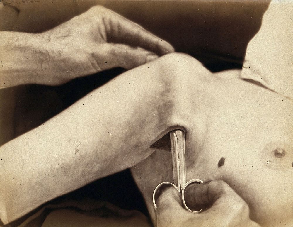An operation in progress: a metal surgical implement is placed inside an incision in the armpit. Photograph by Félix Méheux…