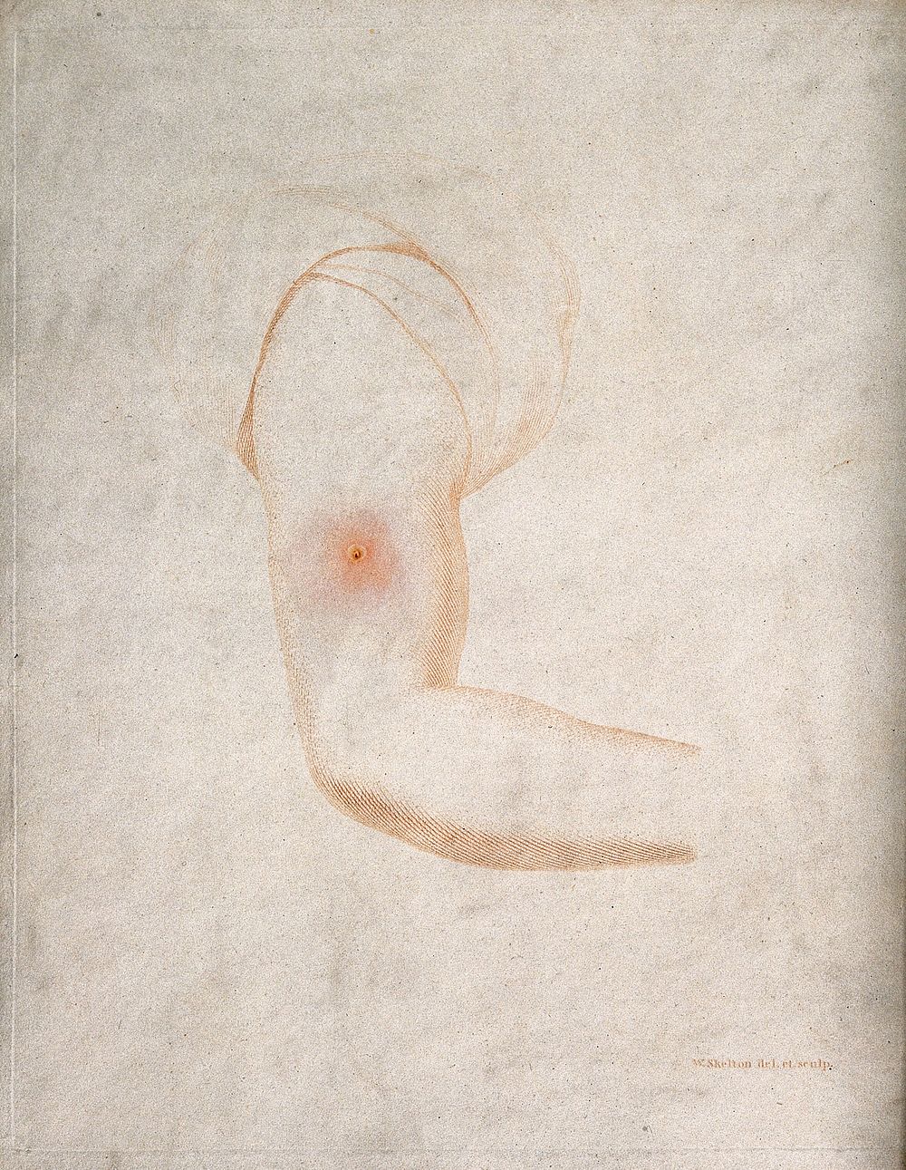 An arm with a vaccine pustule. Coloured etching by W. Skelton after himself.
