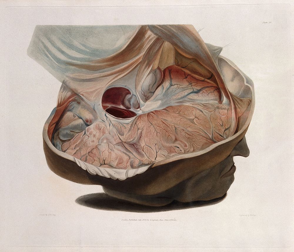Dissected head of James Cardinal with top of skull removed to expose brain deformation. Coloured aquatint by W. Say after F.…