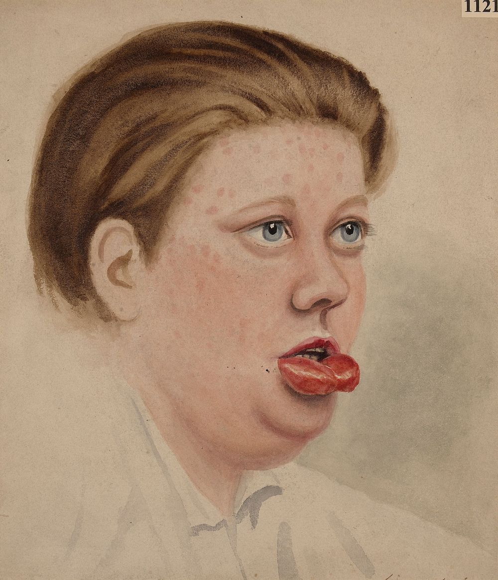Face of a girl with a primary syphilitic sore on the lower lip