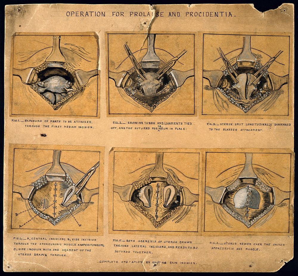 Six diagrams illustrating an operation | Free Photo Illustration - rawpixel