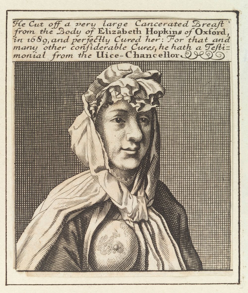 Elizabeth Hopkins of Oxford, showing a breast with cancer which was removed by Sir William Read. Engraving by M. Burghers…