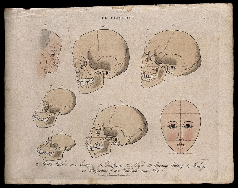 A profile of an old mentally disabled man, skulls of various races, skulls of a monkey and an orangutan, and a perfect…