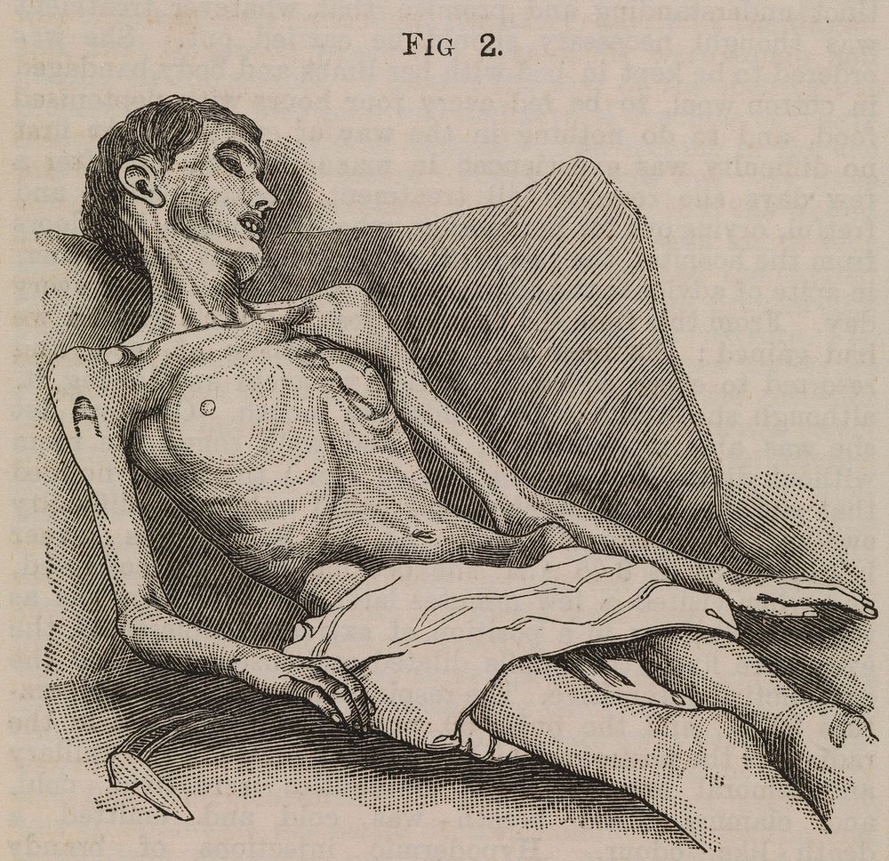 A woman suffering from extreme emaciation (anorexia nervosa)