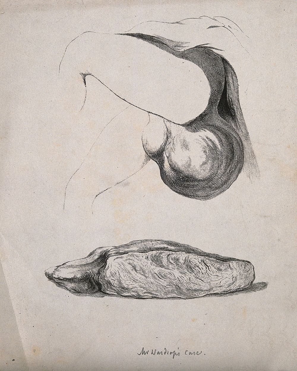 The lower half of a man with a greatly enlarged scrotum; and a diseased part of the body. Lithograph.
