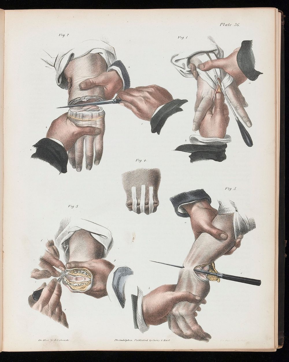 A treatise on operative surgery comprising a description of the various processes of the art, including all the new…