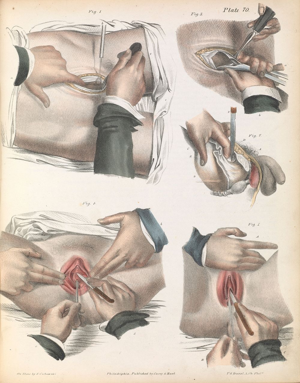 Plate LXX. Surgical technique for lithotomy.