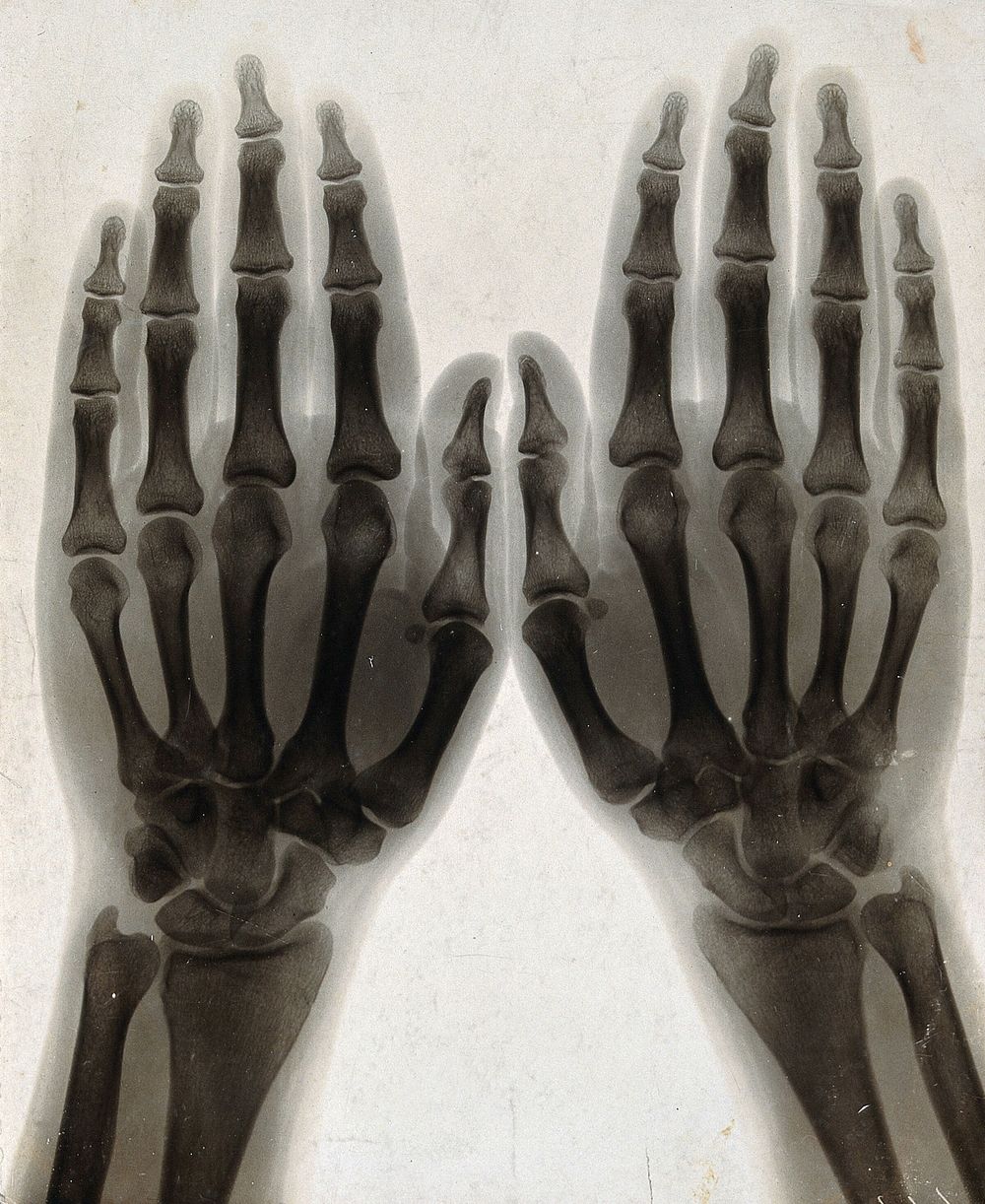 Two hands, viewed through x-ray. Photoprint from radiograph after Sir Arthur Schuster, 1896.