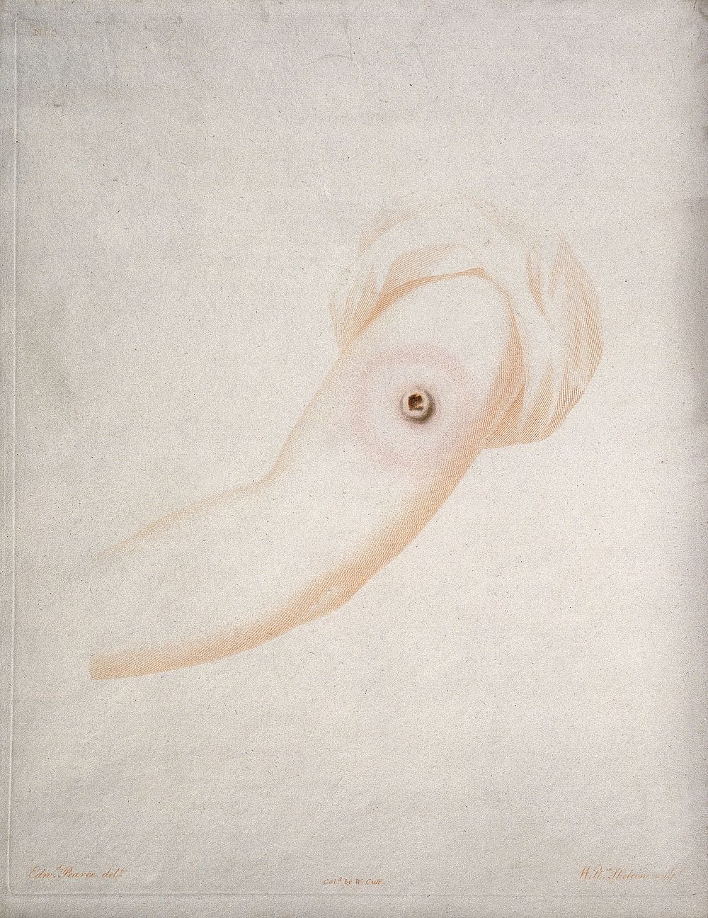 An arm with a vaccine pustule. Coloured etching by W. Cuff and W. Skelton after E. Pearce.