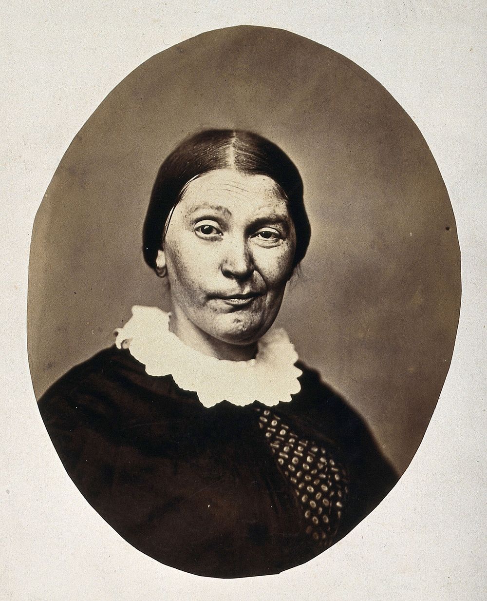 A woman's head and shoulders; her mouth is twisted into a grimace. Photograph by L. Haase after H.W. Berend, 1864.