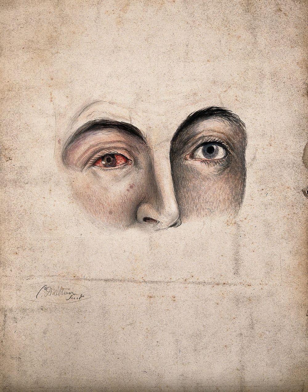 A section of a face (eyes and nose) with a disease affecting one eye. Watercolour by Christopher D' Alton.
