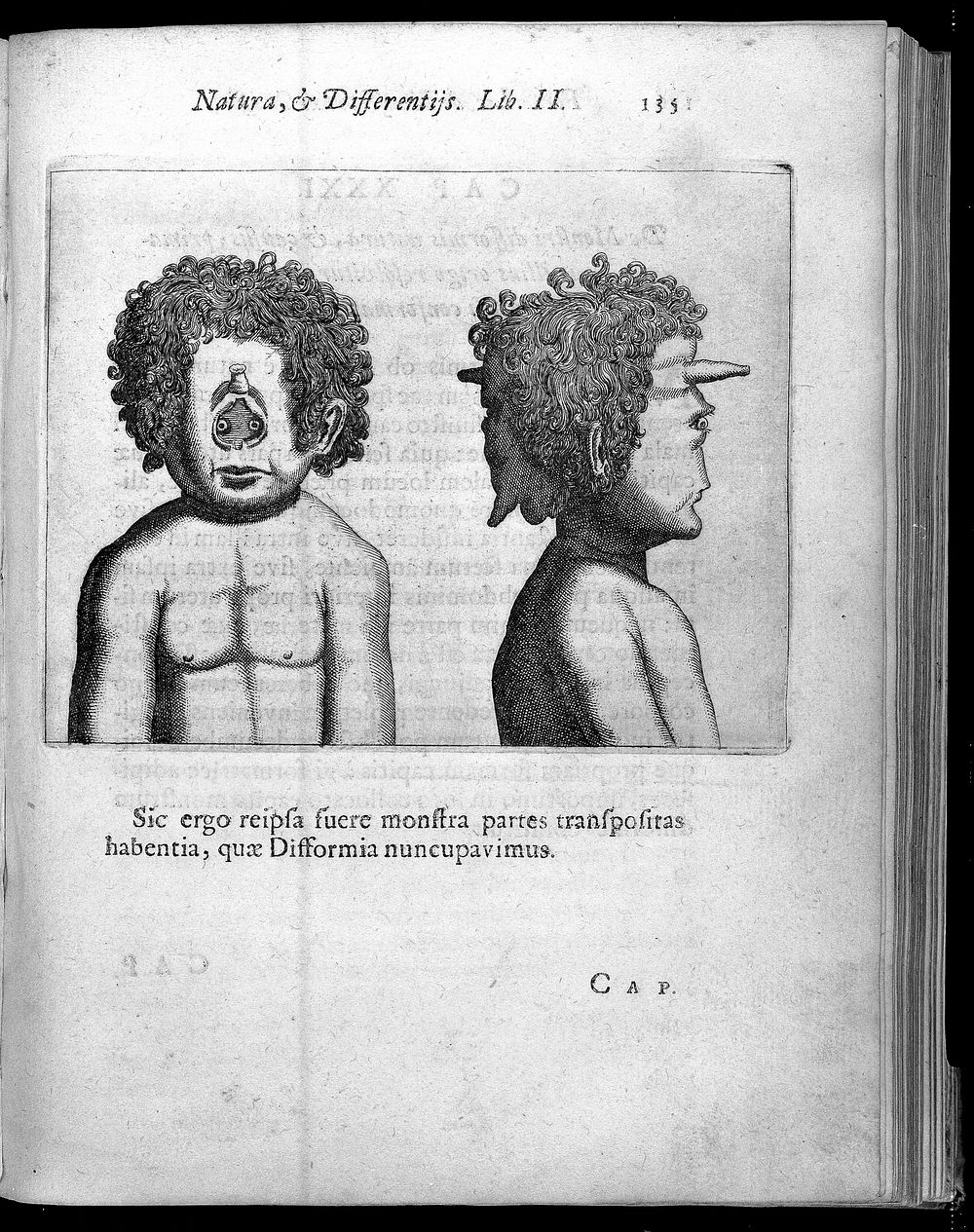 Two human heads with abnormality, one frontal view with no nose and one profile with large nose