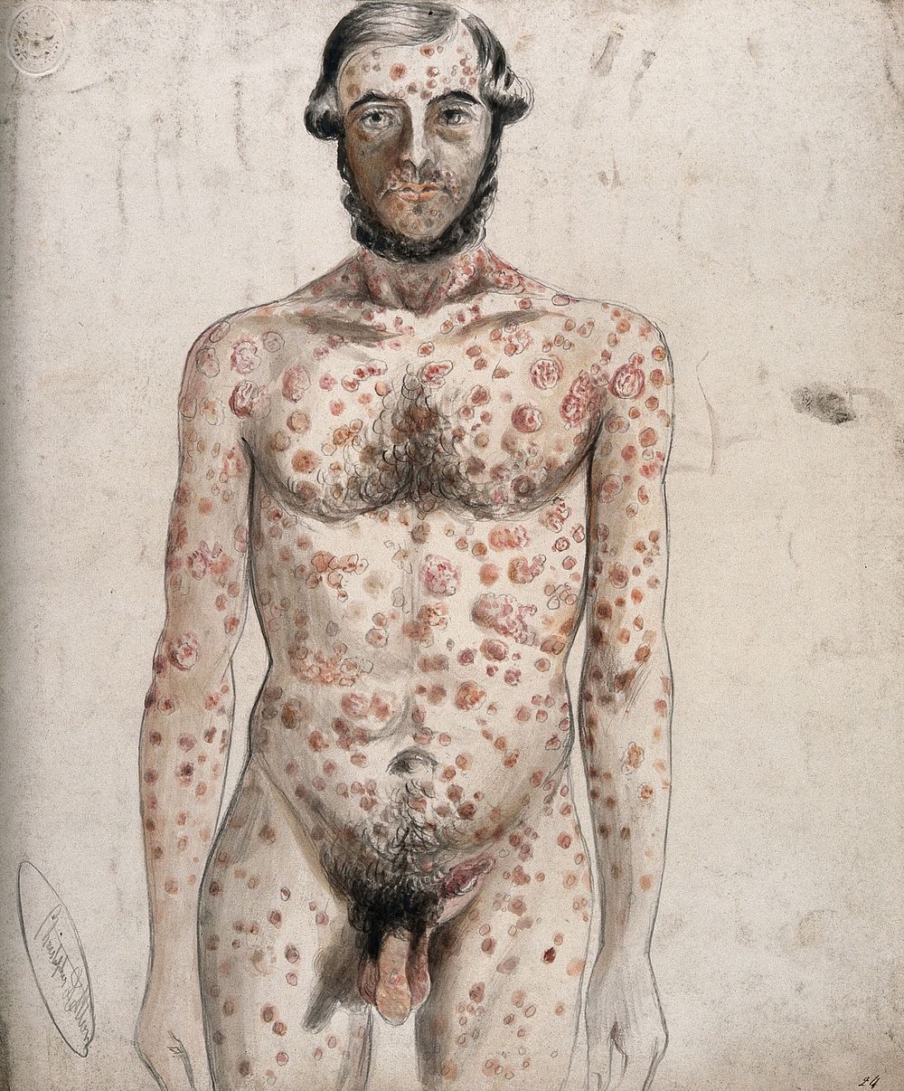 Sores and abcesses  covering the face and body of a man. Watercolour by C. D'Alton, ca. 1853.