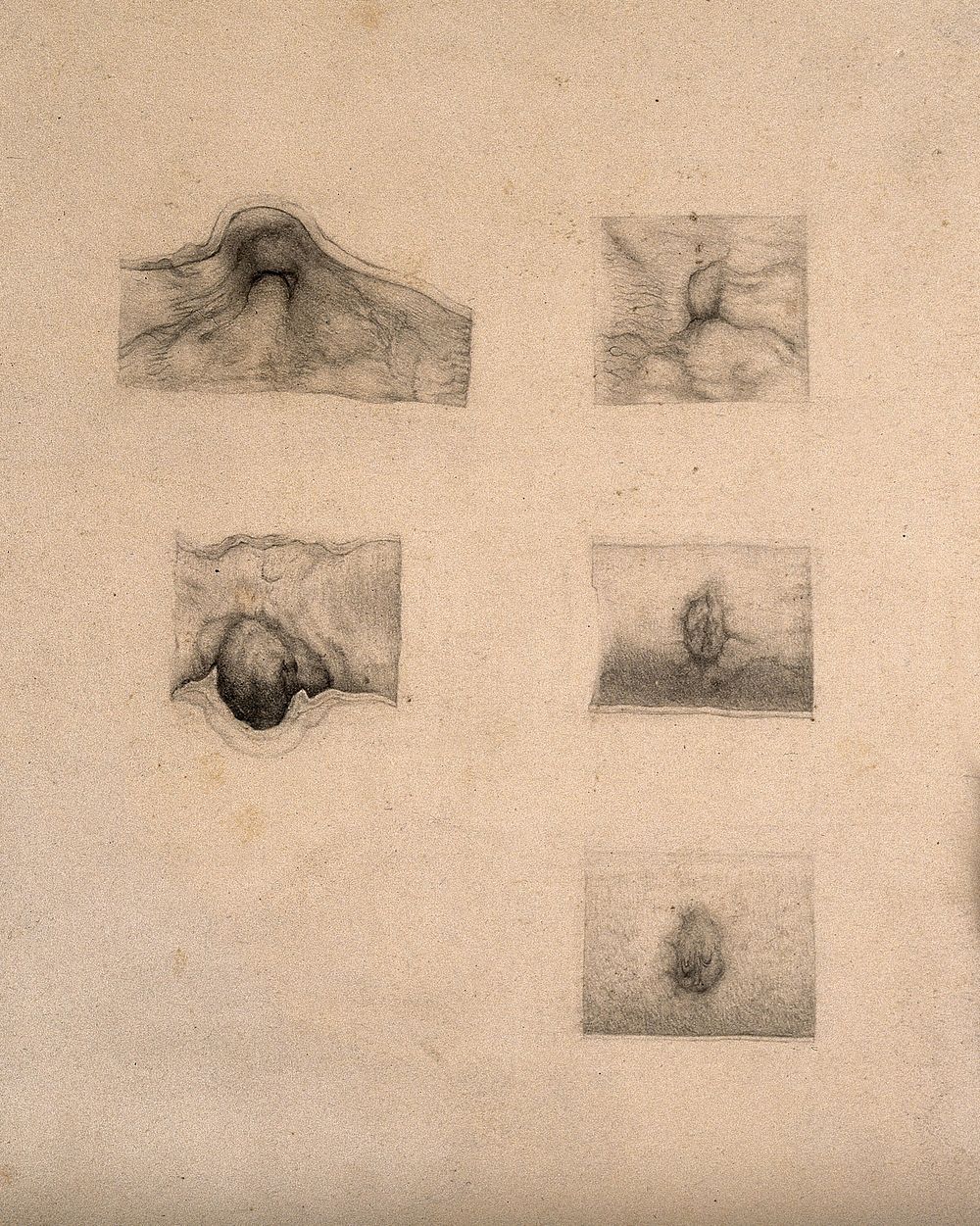 Five diseased parts of the body; detail. Drawing.