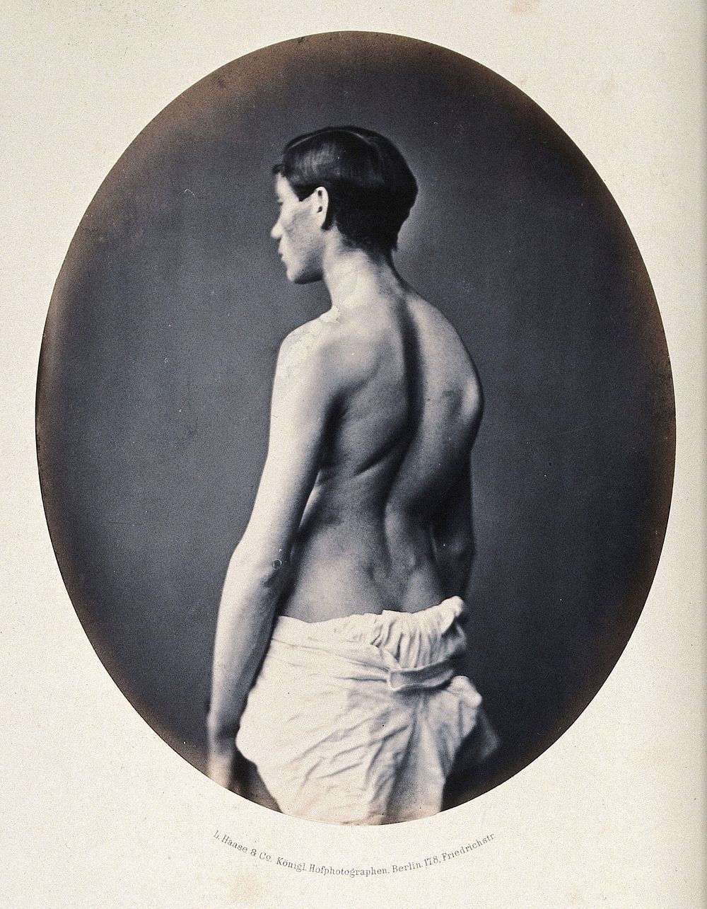 A standing young man, 3/4 length view, partially clothed; showing a deformity of the right shoulder blade. Photograph by L.…