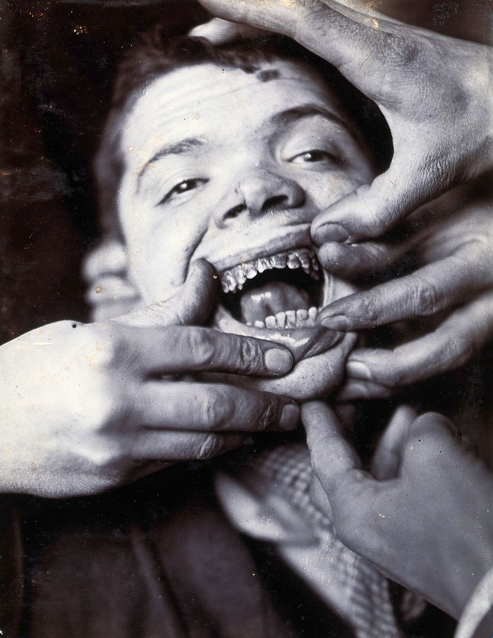 Friern Hospital, London: a boy with rotten teeth. Photograph, 1890/1910.