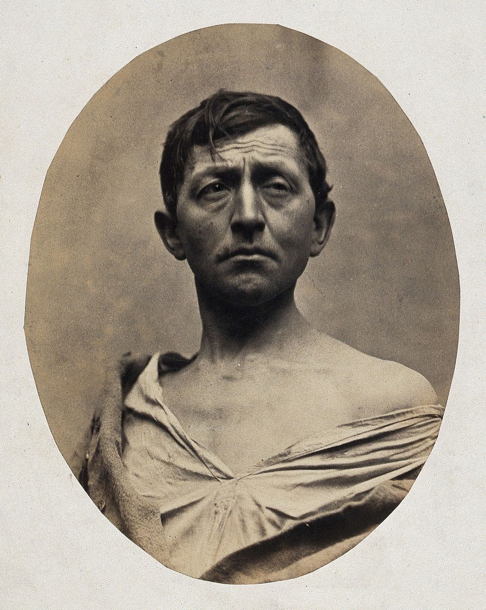 A man, head and shoulders; his shirt undone. Photograph by L. Haase after H.W. Berend, 1863.