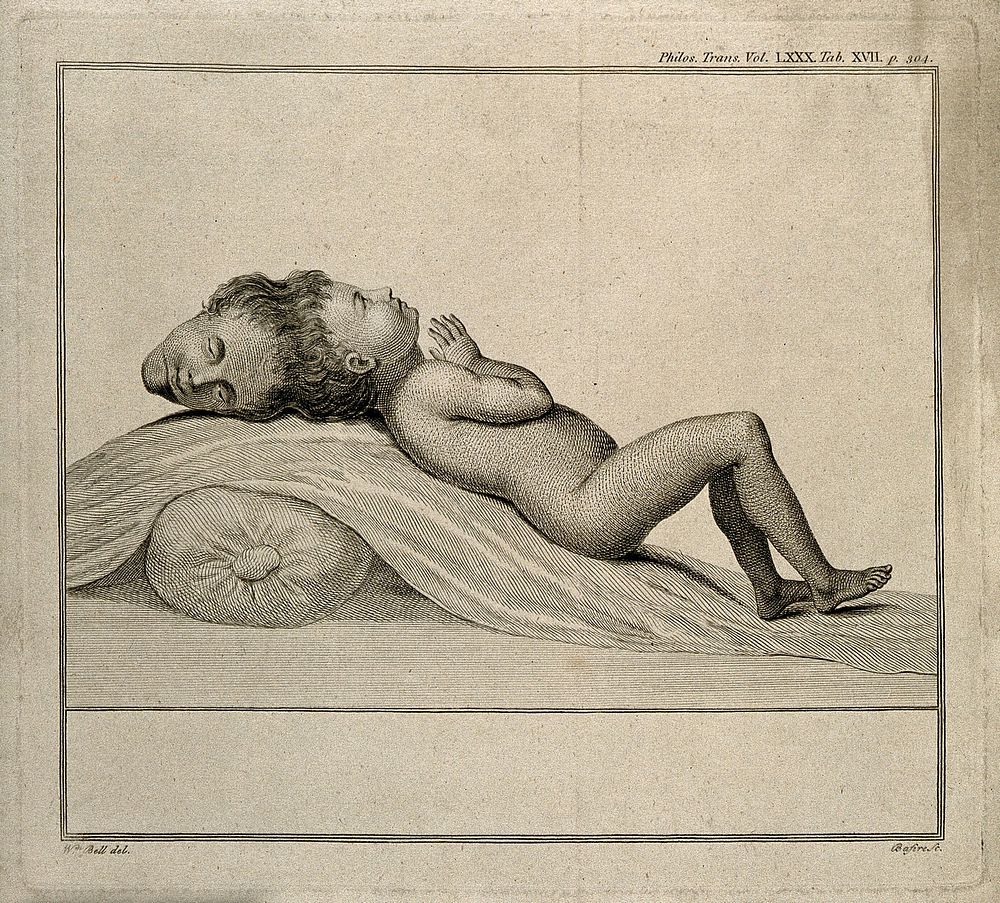 A child with two heads joined at the vertex. Line engraving by J. Basire after W. Bell.
