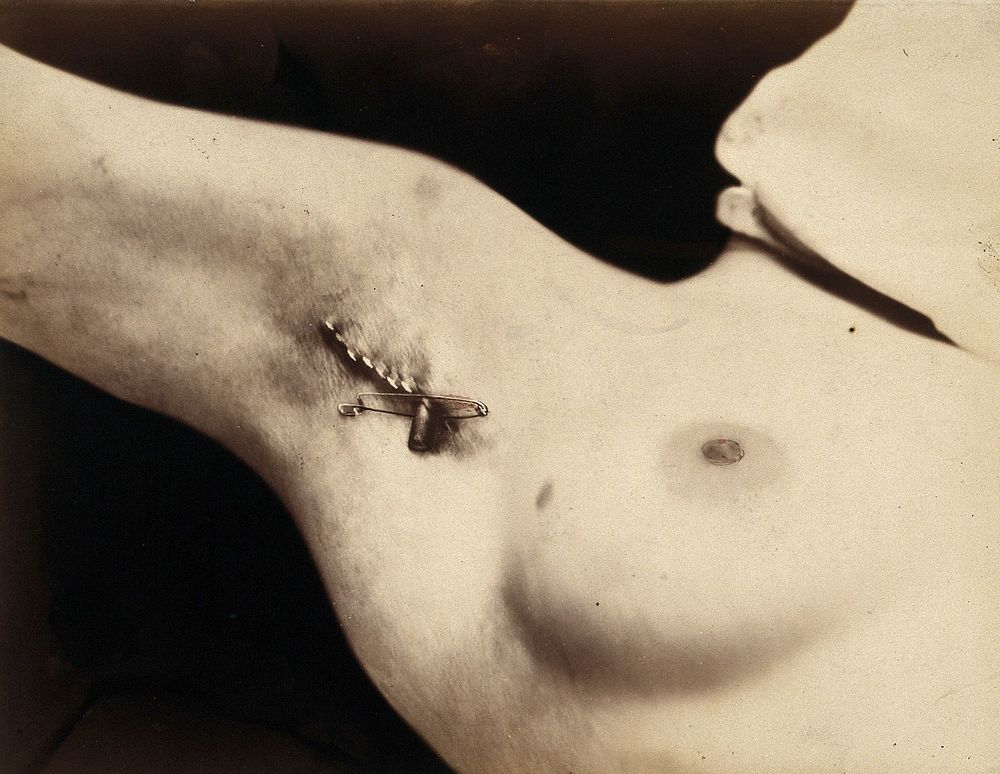 An operation in progress: a metal clip in an incision in the armpit. Photograph by Félix Méheux, ca. 1900.