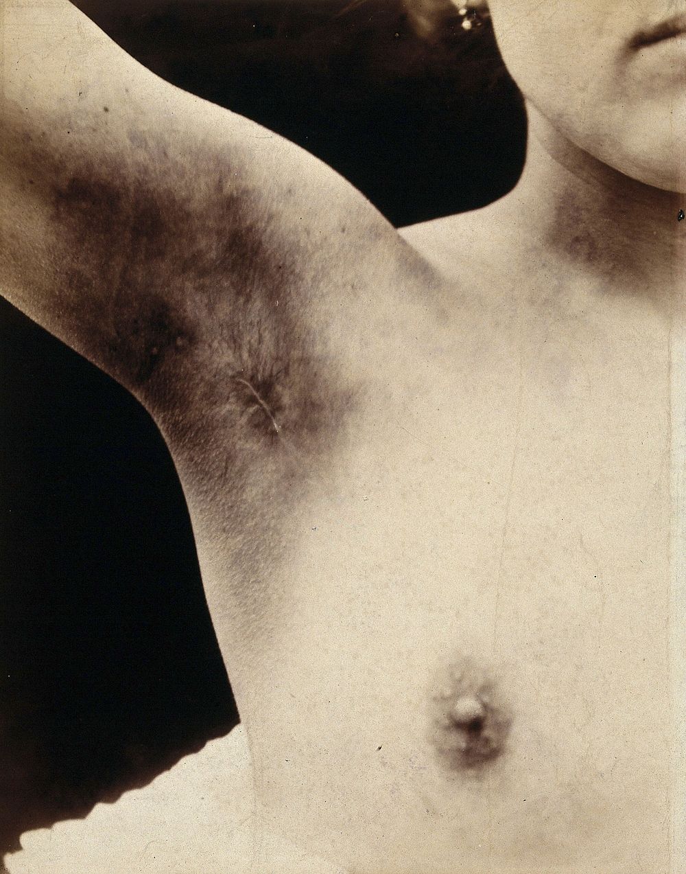 A breast operation to remove a lump, in progress: scarring to the armpit following the operation. Photograph by Félix…