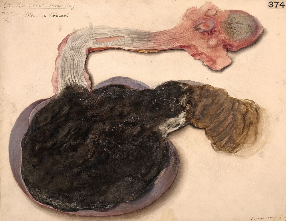 Tongue, oesophagus and stomach from a case of oxalic acid poisoning