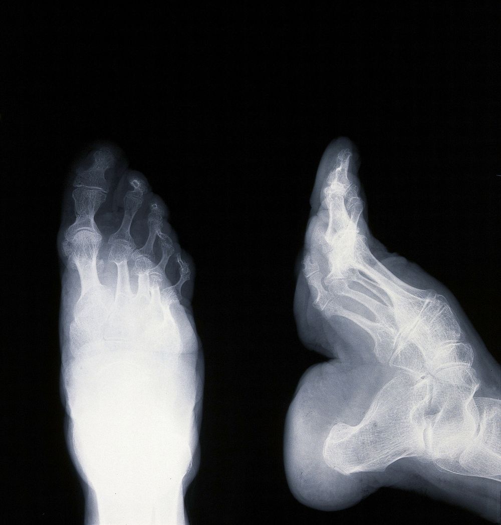 A deformed foot: X-ray. Photograph.