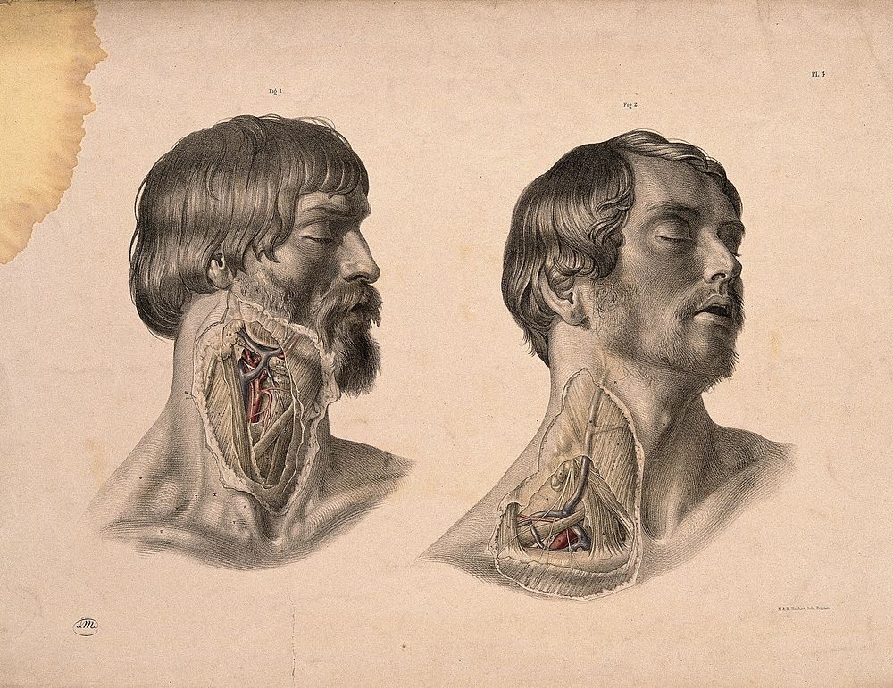 Two heads of men, showing dissection of muscles and blood-vessels of the neck. Coloured lithograph by J. Maclise, 1851.
