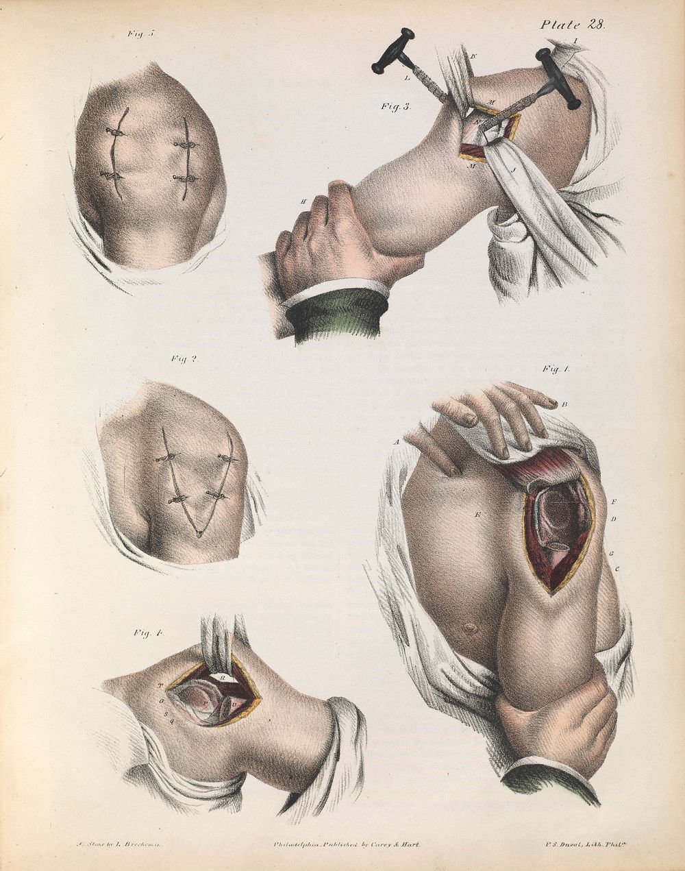 A treatise on operative surgery comprising a description of the various processes of the art, including all the new…