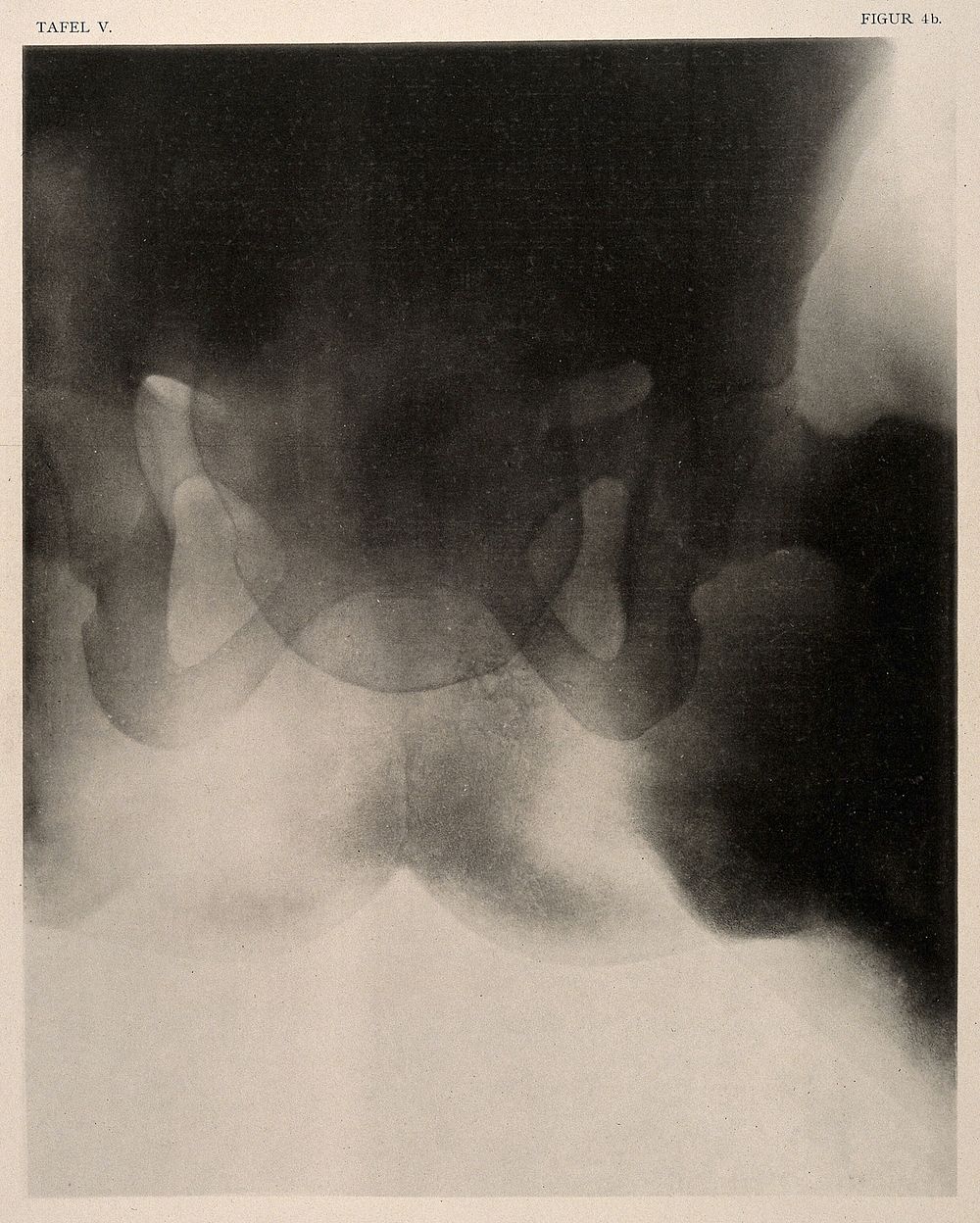 A woman's narrow pelvis with child's head stuck in the middle of a labour. Collotype by Römmler & Jonas after a radiograph…