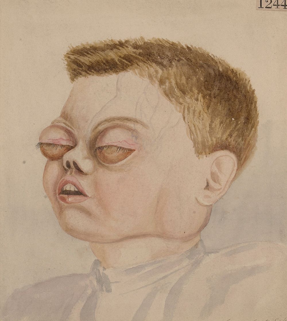 Boy with multiple chloromata of the orbit, internal ear, cerebral dura mater, etc