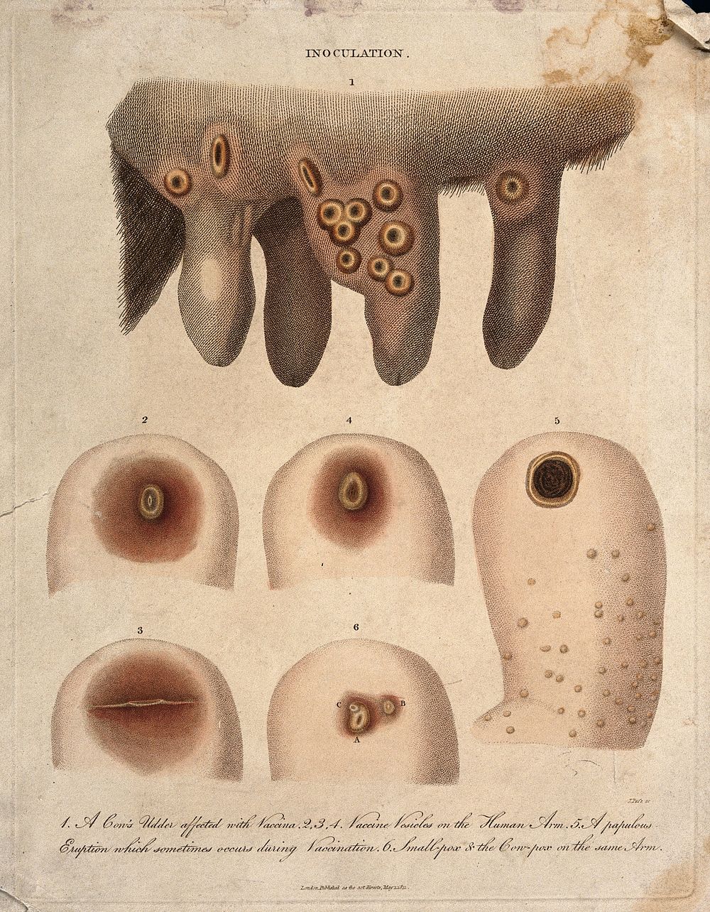 A cow's udder with vaccinia pustules and human arms exhibiting both smallpox and cowpox pustules. Coloured engraving by J.…