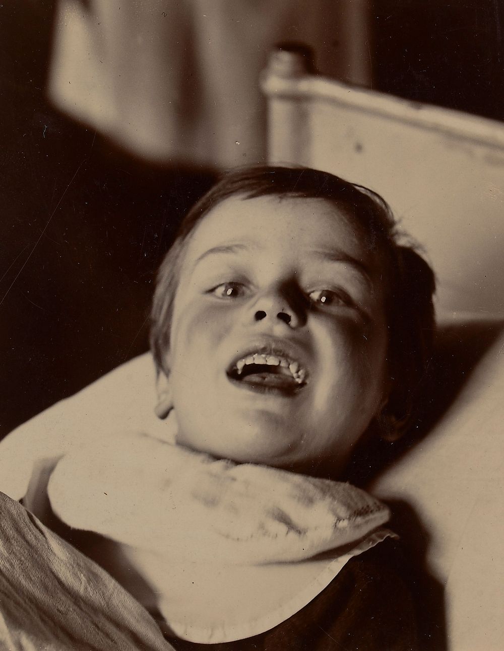 Child possibly suffering from diphtheritic paralysis of the lips and tongue