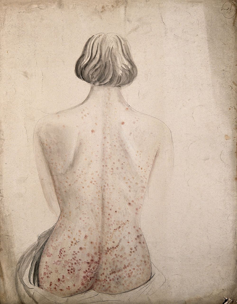 Back and buttocks of a woman suffering from a rash of sores. Watercolour by C. D'Alton, ca. 1850.