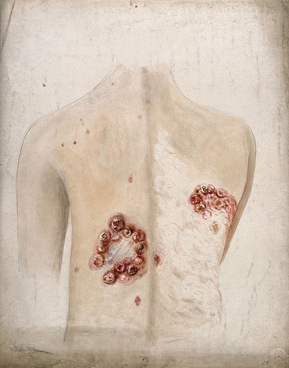 Clusters of abcesses or sores on the back of a woman. Watercolour by C. D'Alton, 1857.