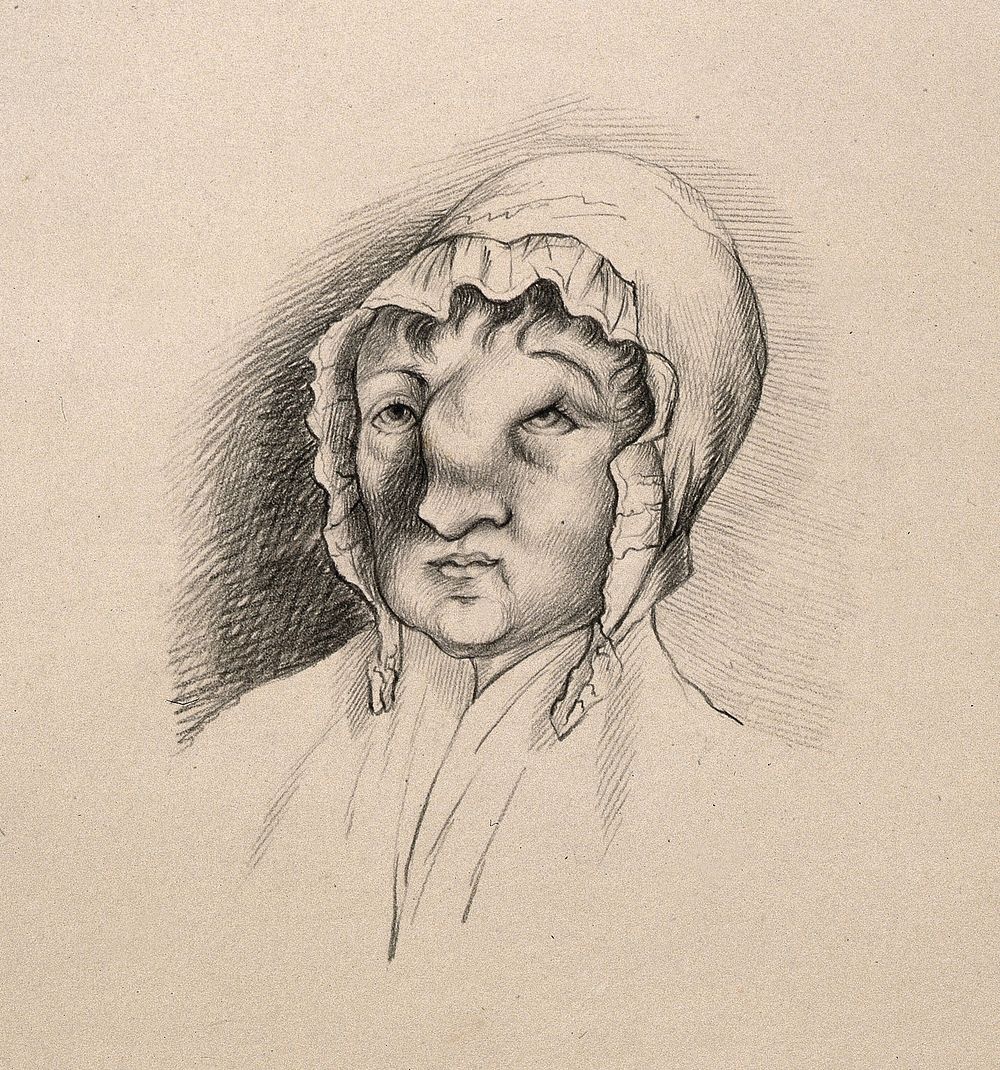 Head of a woman with a deformed nose and forehead. Drawing.