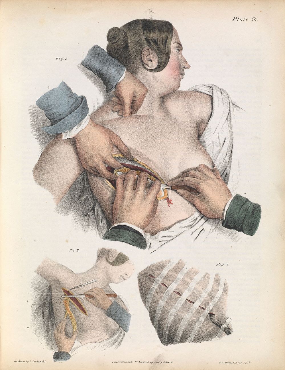 Plate LVI. Surgery for the removal of the mammary gland.