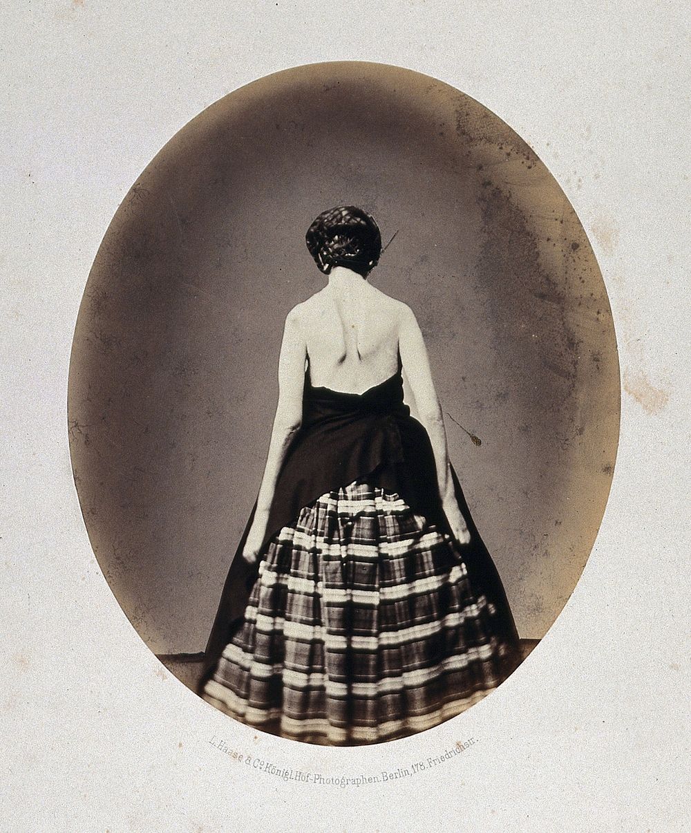 A standing woman, viewed from behind whose striped skirt has been covered with black cloth, revealing her arms and…