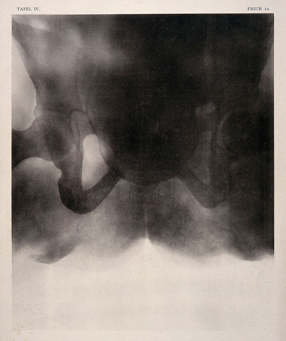 A woman's narrow pelvis with child's head stuck in the middle of labour. Collotype by Römmler & Jonas after a radiograph…