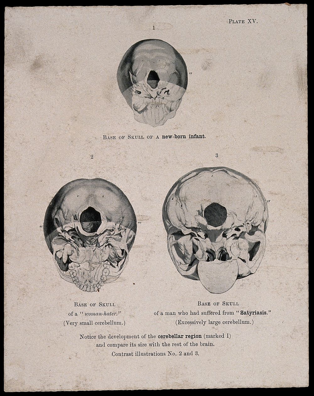 The bases of three skulls: a new born infant's, a misogynist's, and a man suffering from satyriasis. Process print, 1901…