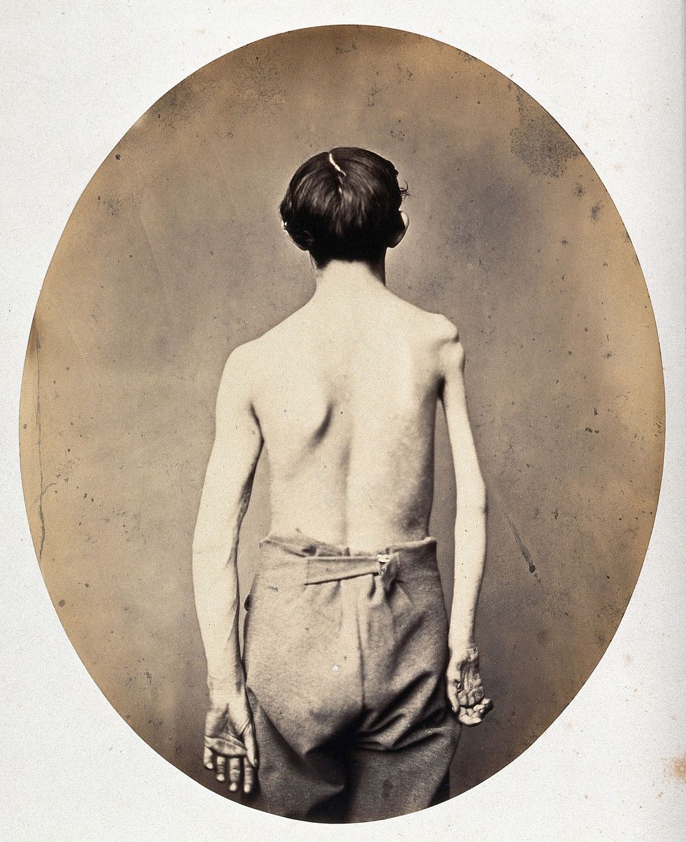 A partially clothed man, standing, viewed from the back; his right arm and shoulder appear severely deformed. Photograph by…