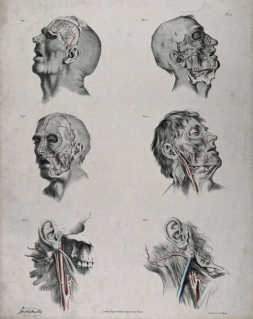 The circulatory system: six dissections of the male face and neck, with arteries, blood vessels and veins indicated in red…