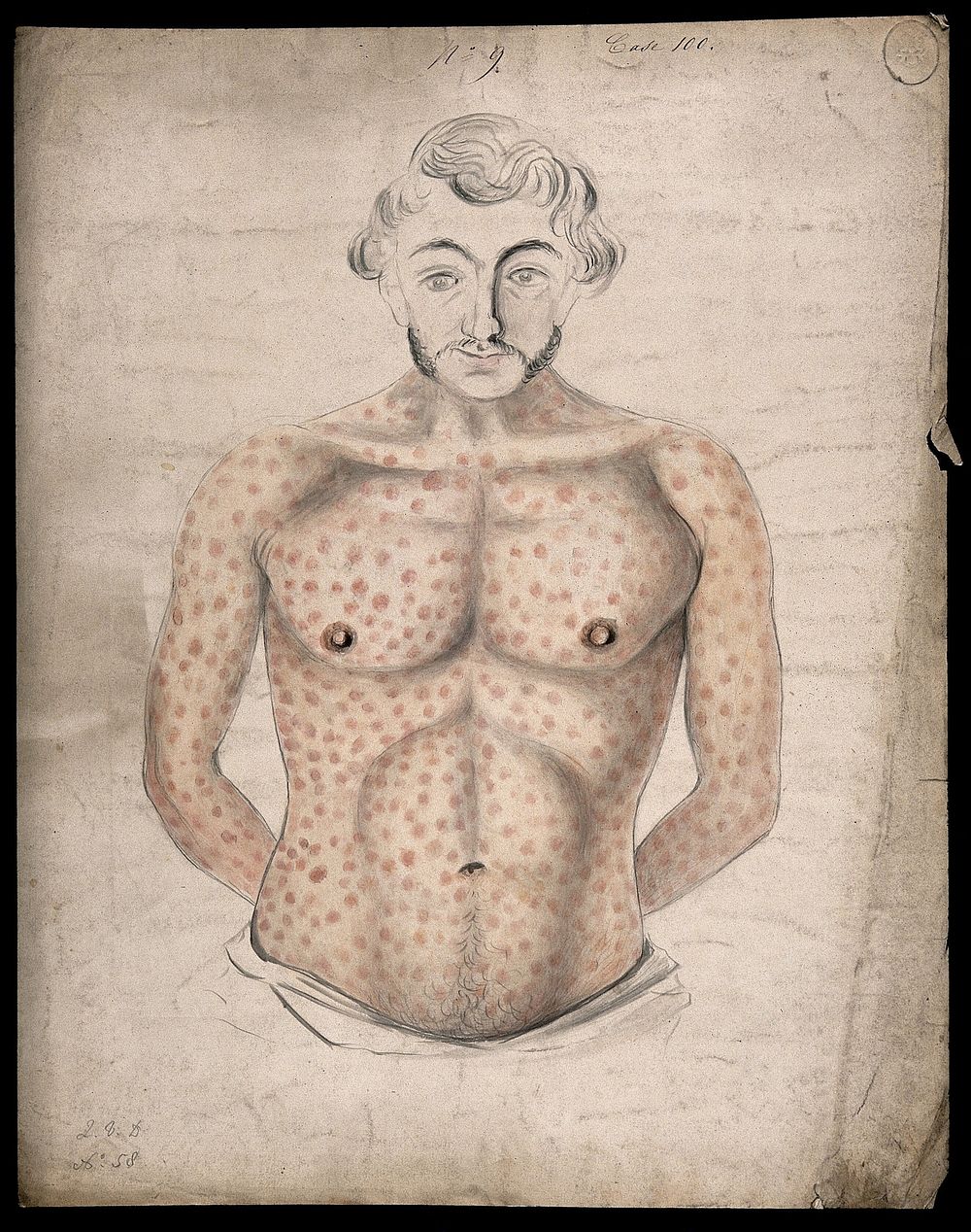 The torso and arms of a man suffering from a rash of sores. Watercolour by C. D'Alton, 1856.